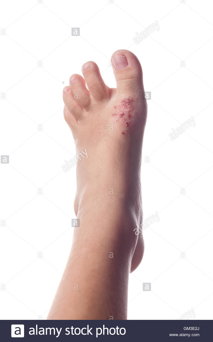Eczema Child Stock Photos & Eczema Child Stock Images Alamy