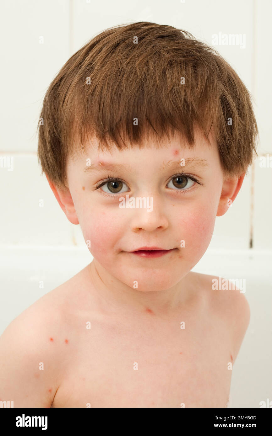 chicken pox Stock Photo