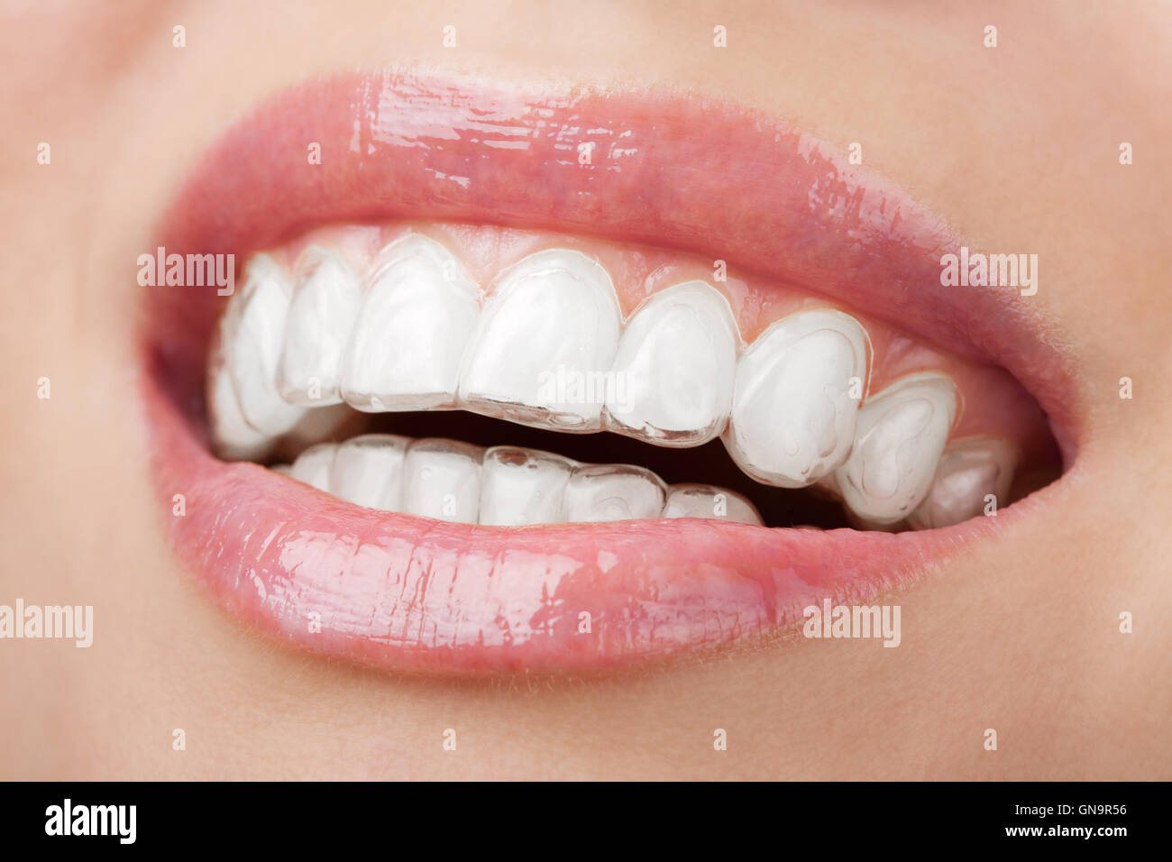 teeth with whitening tray Stock Photo Alamy