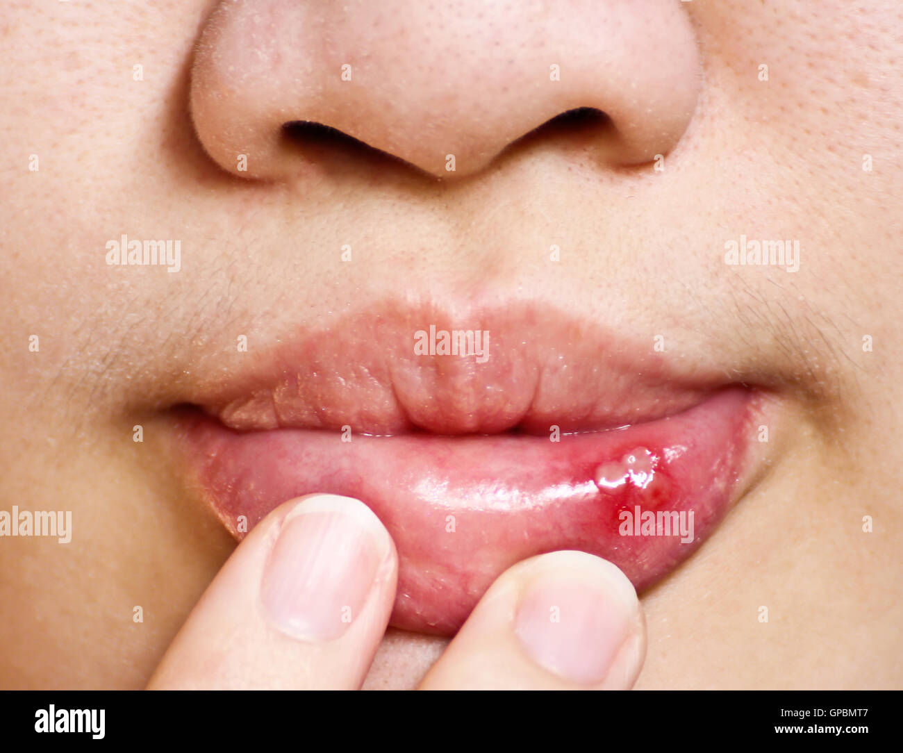 Mouth ulcer hires stock photography and images Alamy