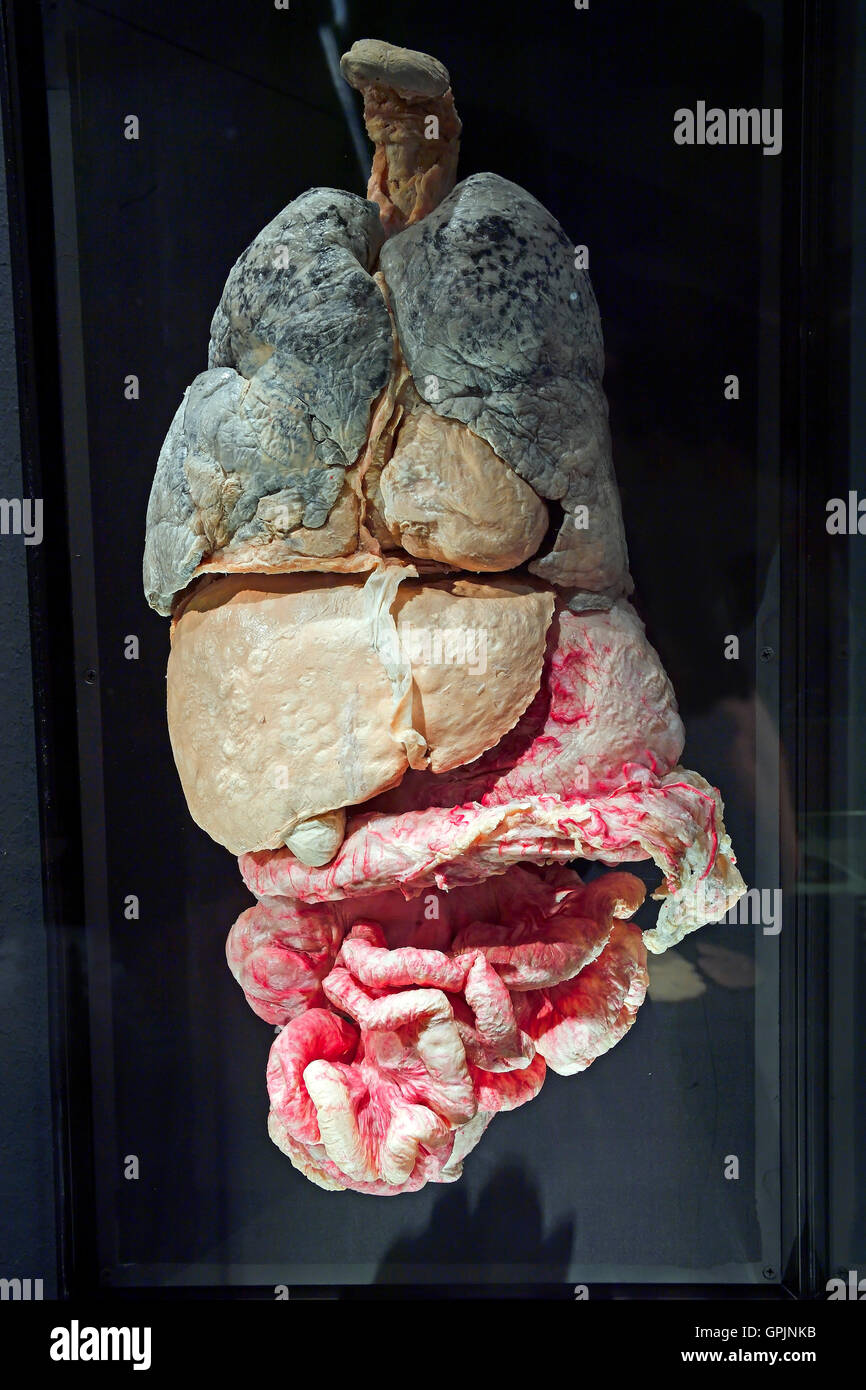 Plastinate, human abdomen, internal organs with metastases, Body Worlds, Menschen Museum, Berlin, Germany Stock Photo