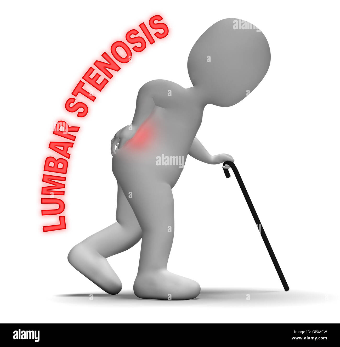 Lumbar spinal stenosis hires stock photography and images Alamy