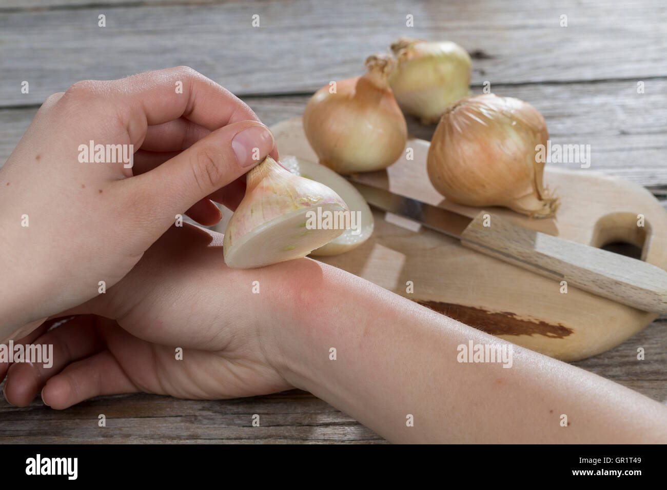 Zwiebel hilft bei Insektenstich, Mückenstich, Mückenstiche, Zwiebelhälfte wird auf die juckende Hautstelle gelegt, Zwiebelauflag Stock Photo