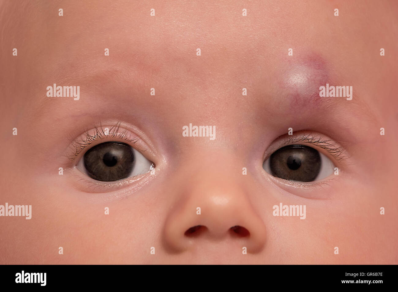 Infant hemangioma on forehead of baby girl, treatment with propranol. Stock Photo