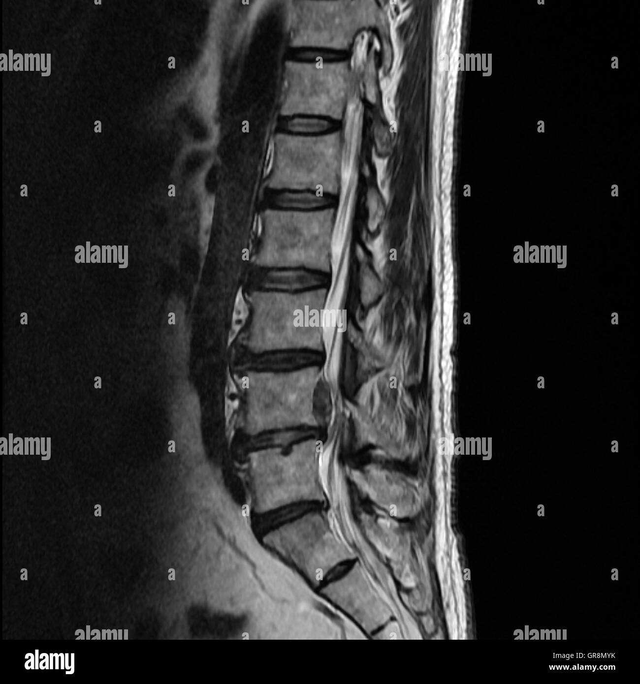 Mri Of A Lumbar-Disk Herniation Stock Photo