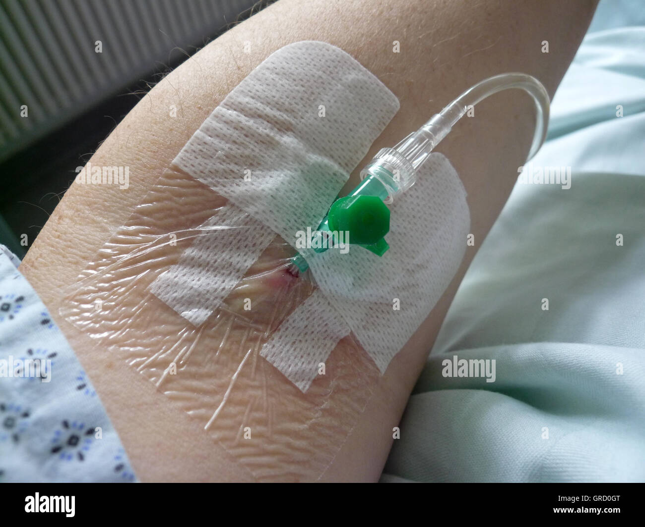 Infusion, A Canula Being Placed Into Arm Vein Stock Photo
