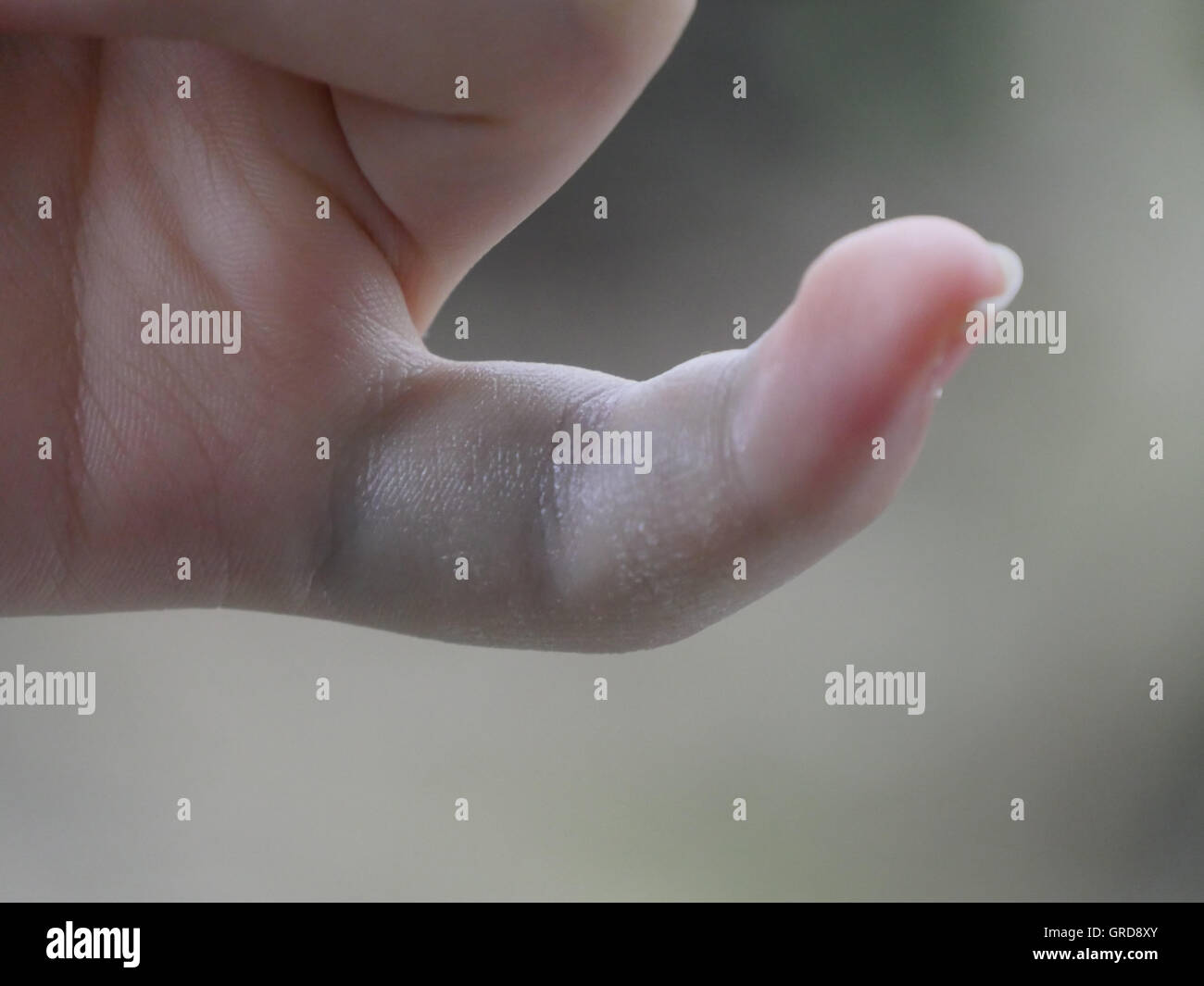 cut eye test c Stock Bruising Photos Stock & Bruising Images Alamy cut eye test c Stock Bruising Photos Stock & Bruising Images Alamy