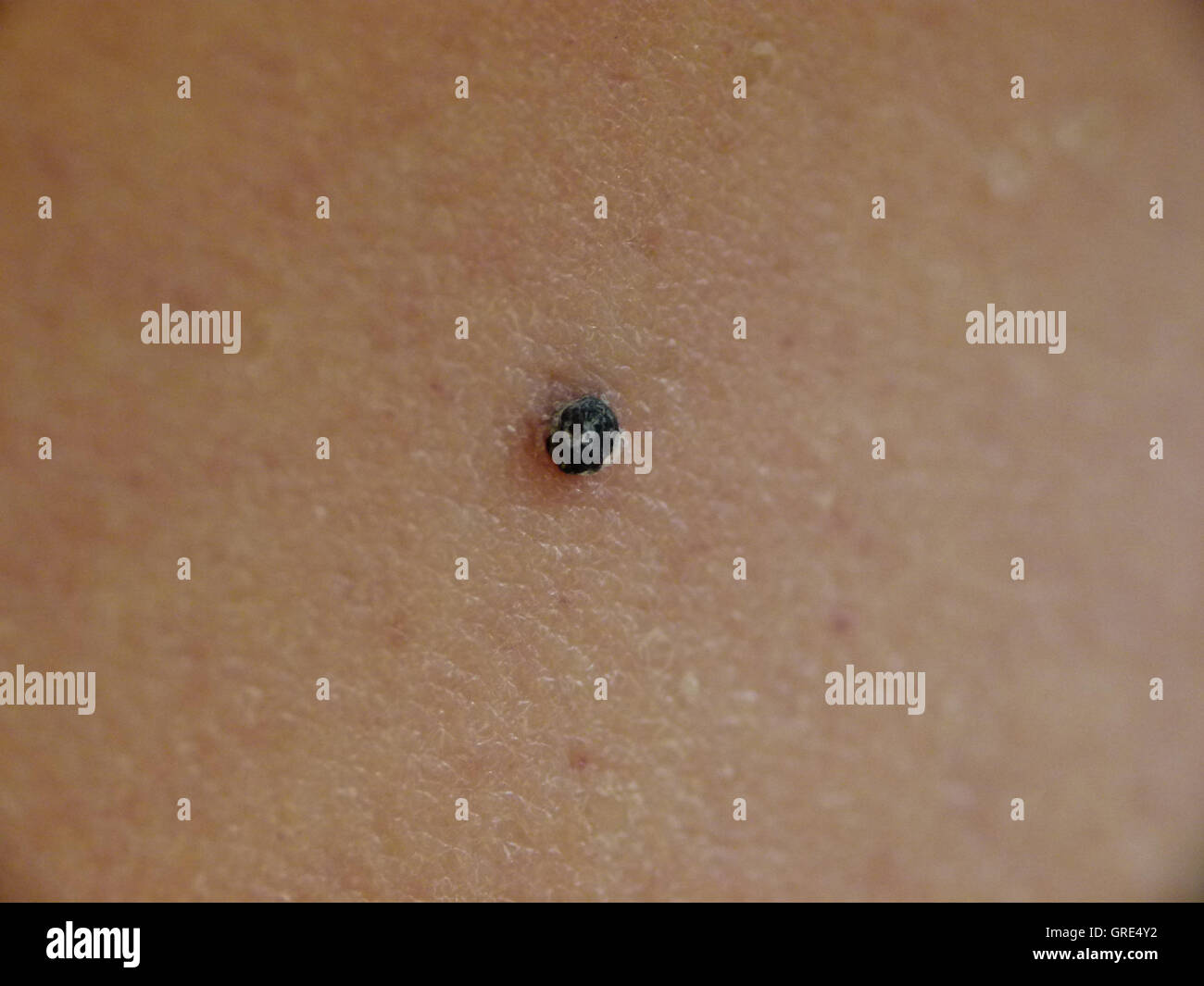 Melanoma High Resolution Stock Photography and Images - Alamy