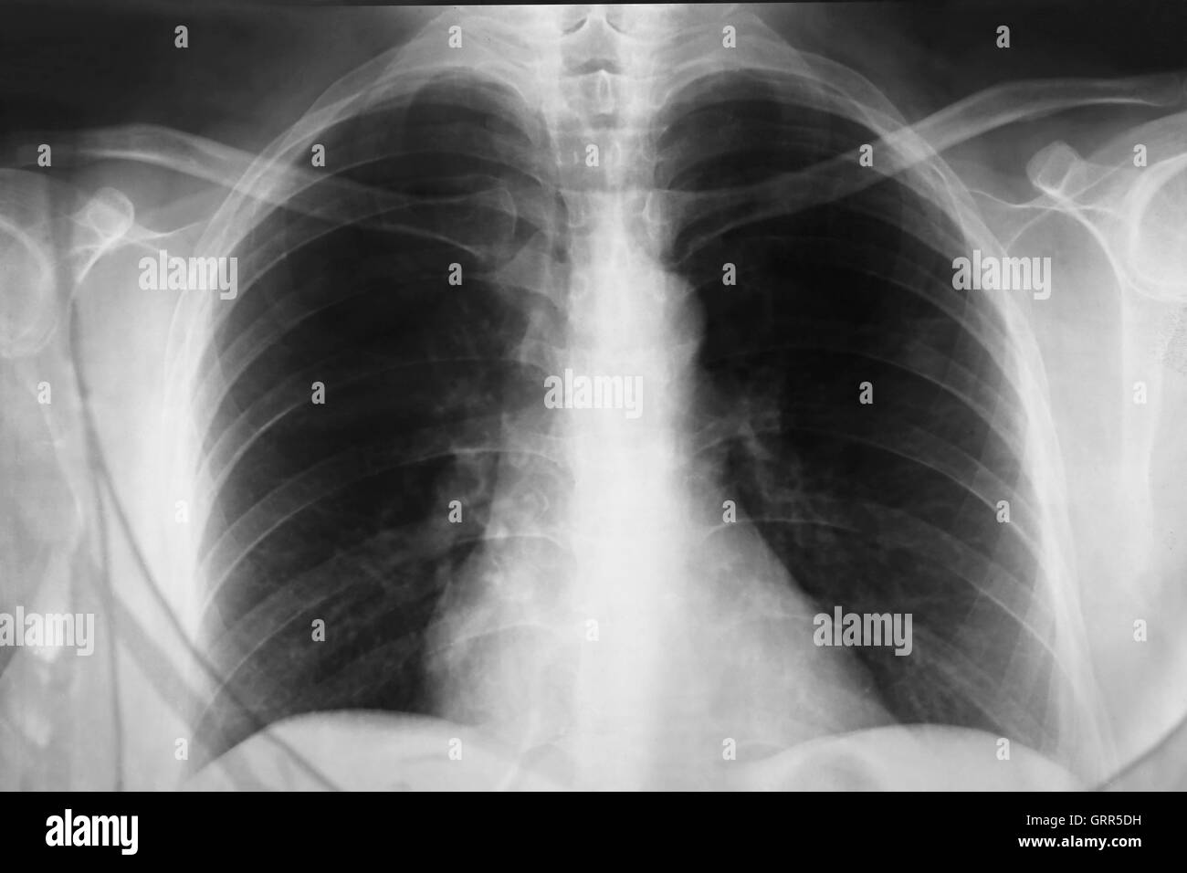 Close up a chest xray Stock Photo