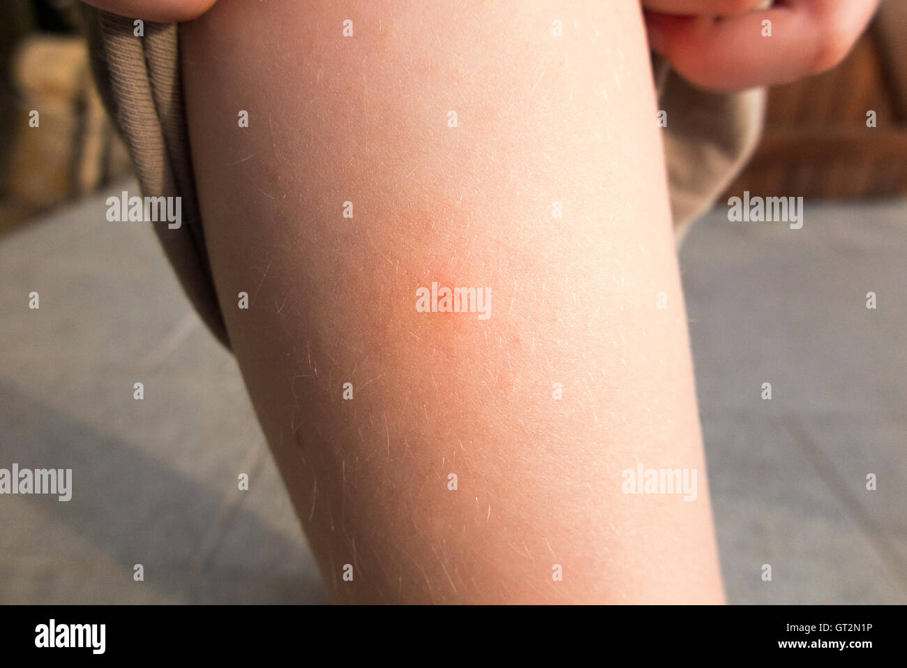 British Child Child S Tourist Swimmer Leg With Inflammation Caused By The Bite Of A Duck Flea Puces De Canard In French Stock Photo Alamy British Child Child S Tourist Swimmer Leg With Inflammation Caused By The Bite Of A Duck Flea Puces De Canard In French Stock Photo Alamy