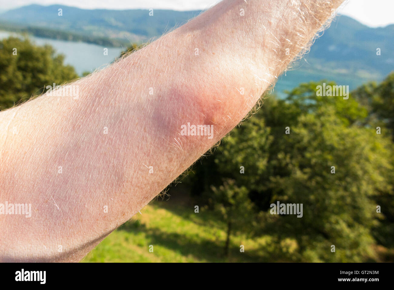 Swimmers Itch High Resolution Stock Photography And Images Alamy Swimmers Itch High Resolution Stock Photography And Images Alamy