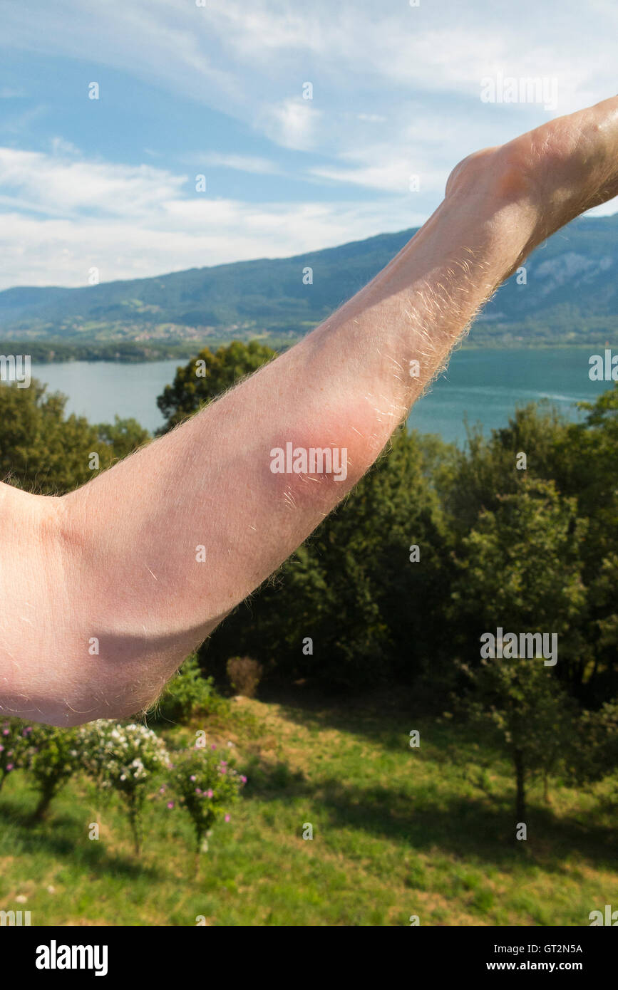The Raised Arm Of A British Tourist Swimmer With Inflammation Caused Stock Photo Alamy The Raised Arm Of A British Tourist Swimmer With Inflammation Caused Stock Photo Alamy