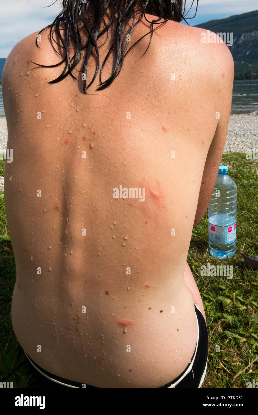 Tourist swimmer at Lac Du Bourget France with inflammation thought caused by Duck flea / fleas parasites French: puces de canard Stock Photo
