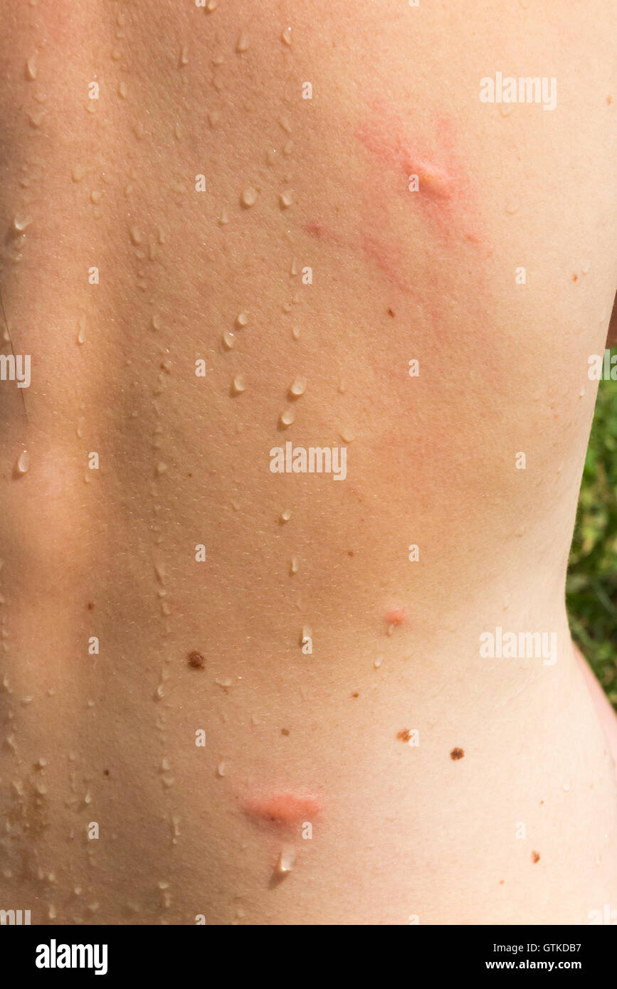 Tourist swimmer at Lac Du Bourget France with inflammation thought caused by Duck flea / fleas parasites French: puces de canard Stock Photo
