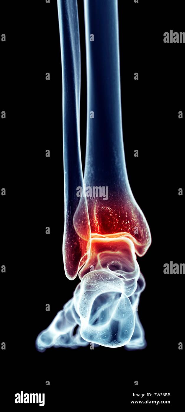 Human ankle pain, illustration Stock Photo - Alamy