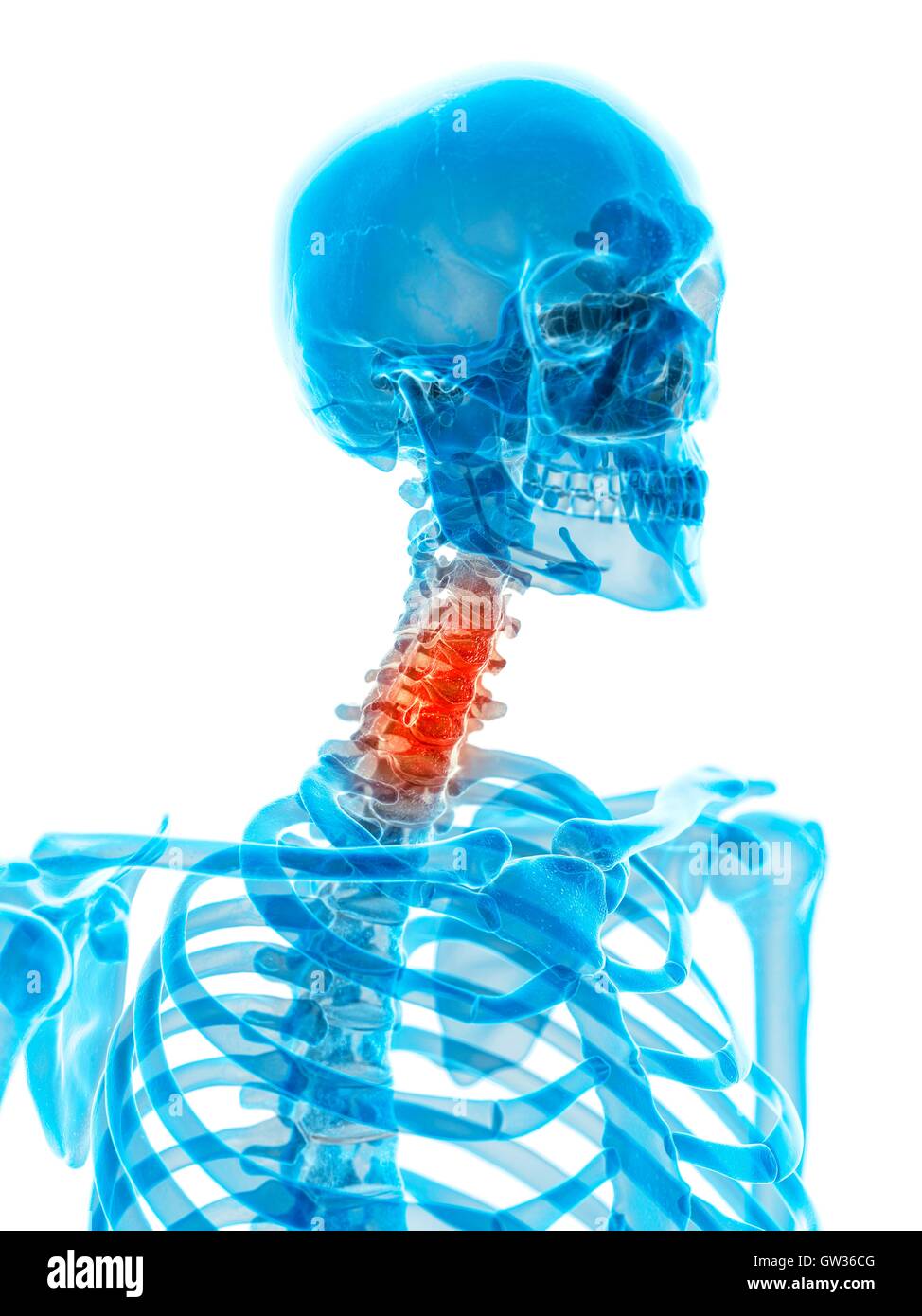 Cervical spine pain hi-res stock photography and images - Alamy