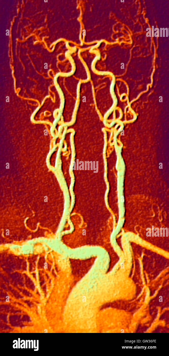 Chest, neck and head arteries. Coloured magnetic resonance angiography (MRA) scan of a normal carotid system of a 55 year old man. Bottom centre is the aortic arch, which curves over the heart. The arteries that branch off from these are: the brachiocepha Stock Photo
