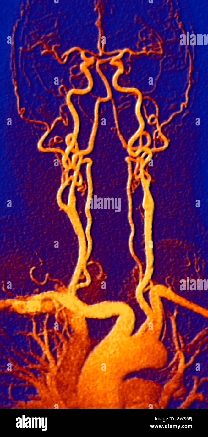 Chest, neck and head arteries. Coloured magnetic resonance angiography (MRA) scan of a normal carotid system of a 55 year old man. Bottom centre is the aortic arch, which curves over the heart. The arteries that branch off from these are: the brachiocepha Stock Photo