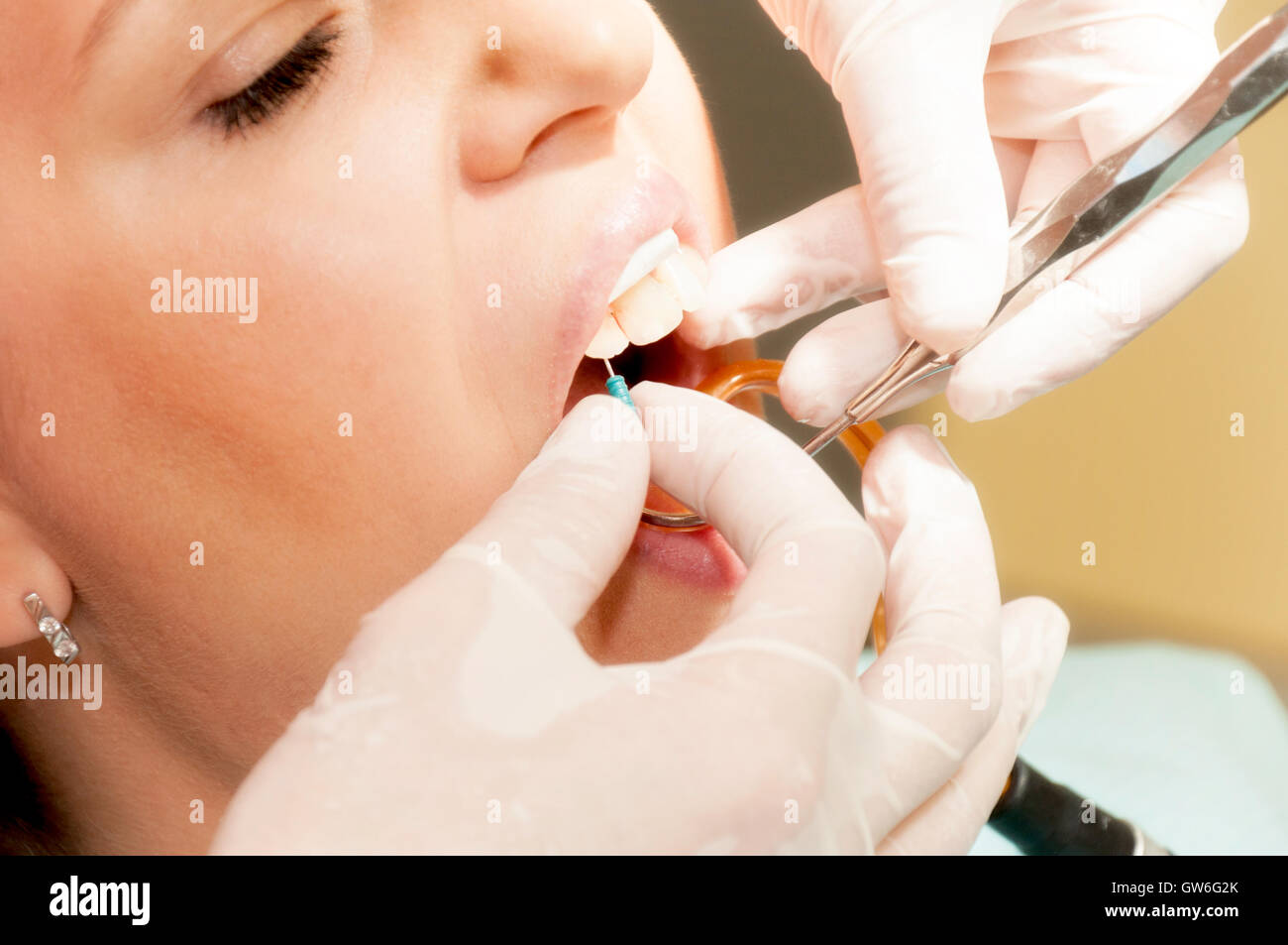 Needle in the tooth Stock Photo Alamy