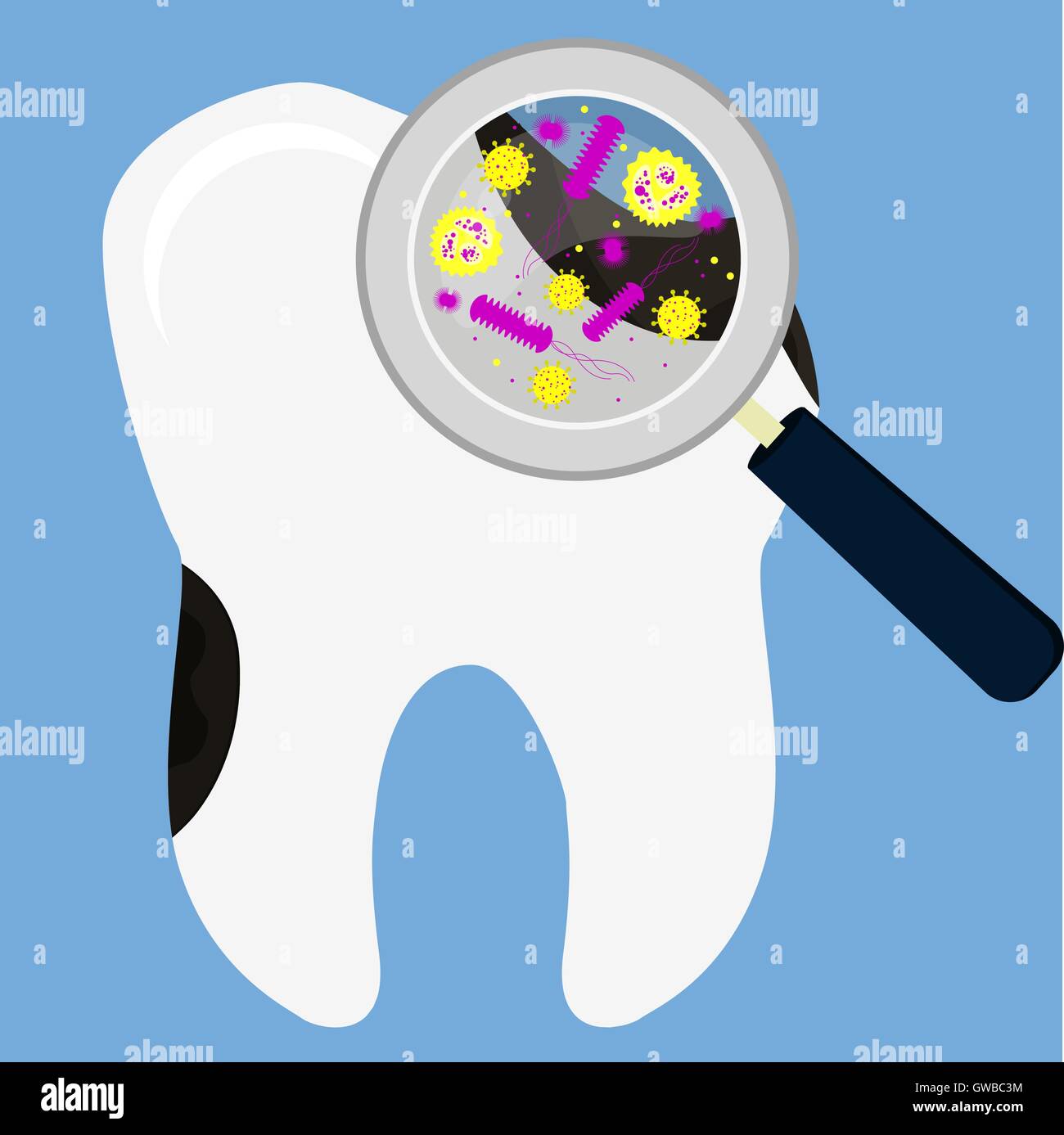 Rotten tooth decay magnified by a magnifying glass. Showing microorganisms, virus and bacteria. Stock Vector
