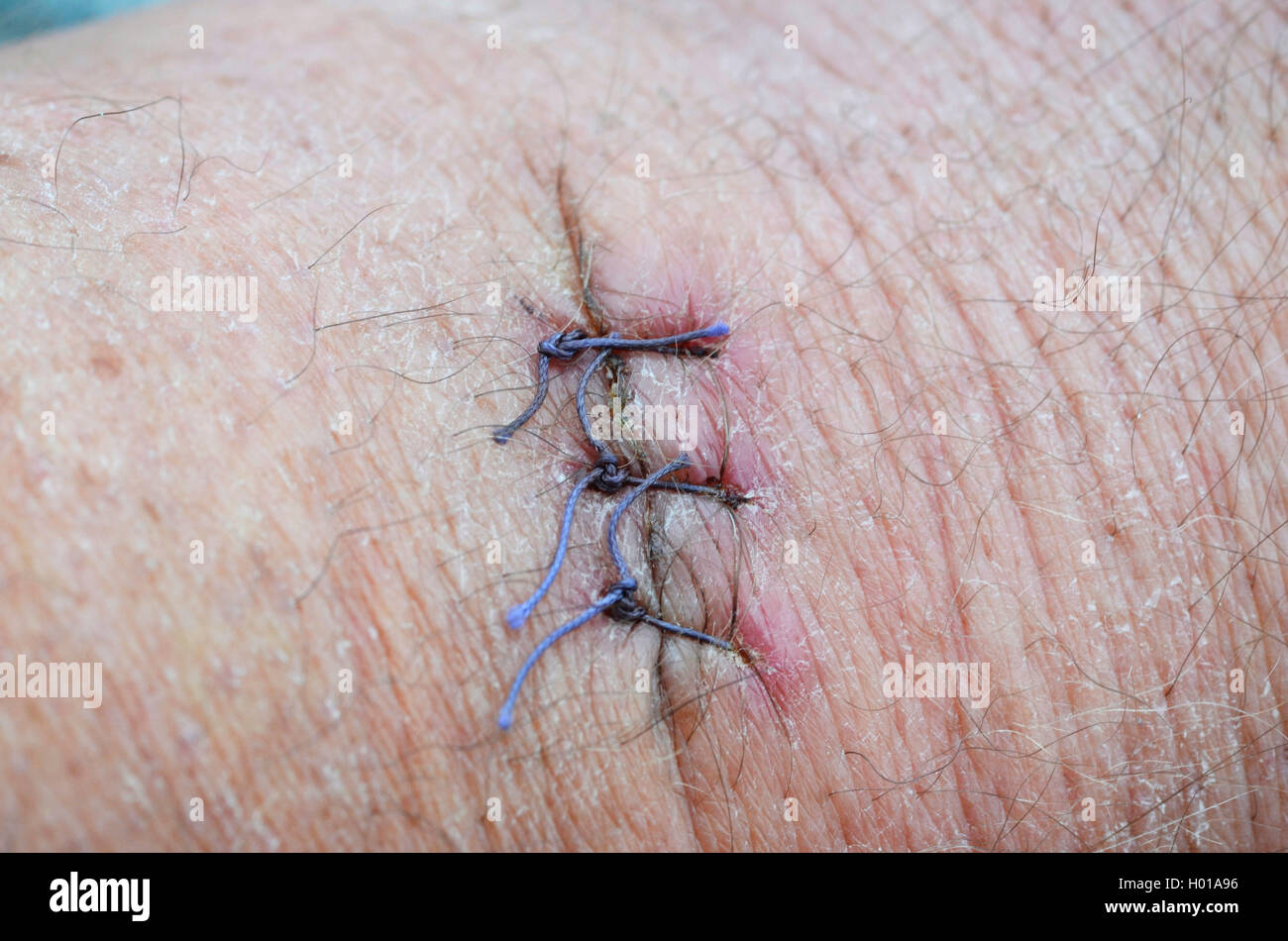 operation scar, three stitches Stock Photo