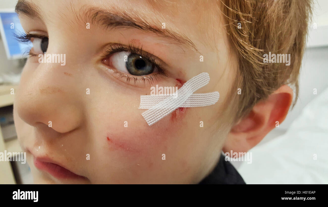 little boy with a wound cared laceration in the face, portrait, Germany Stock Photo