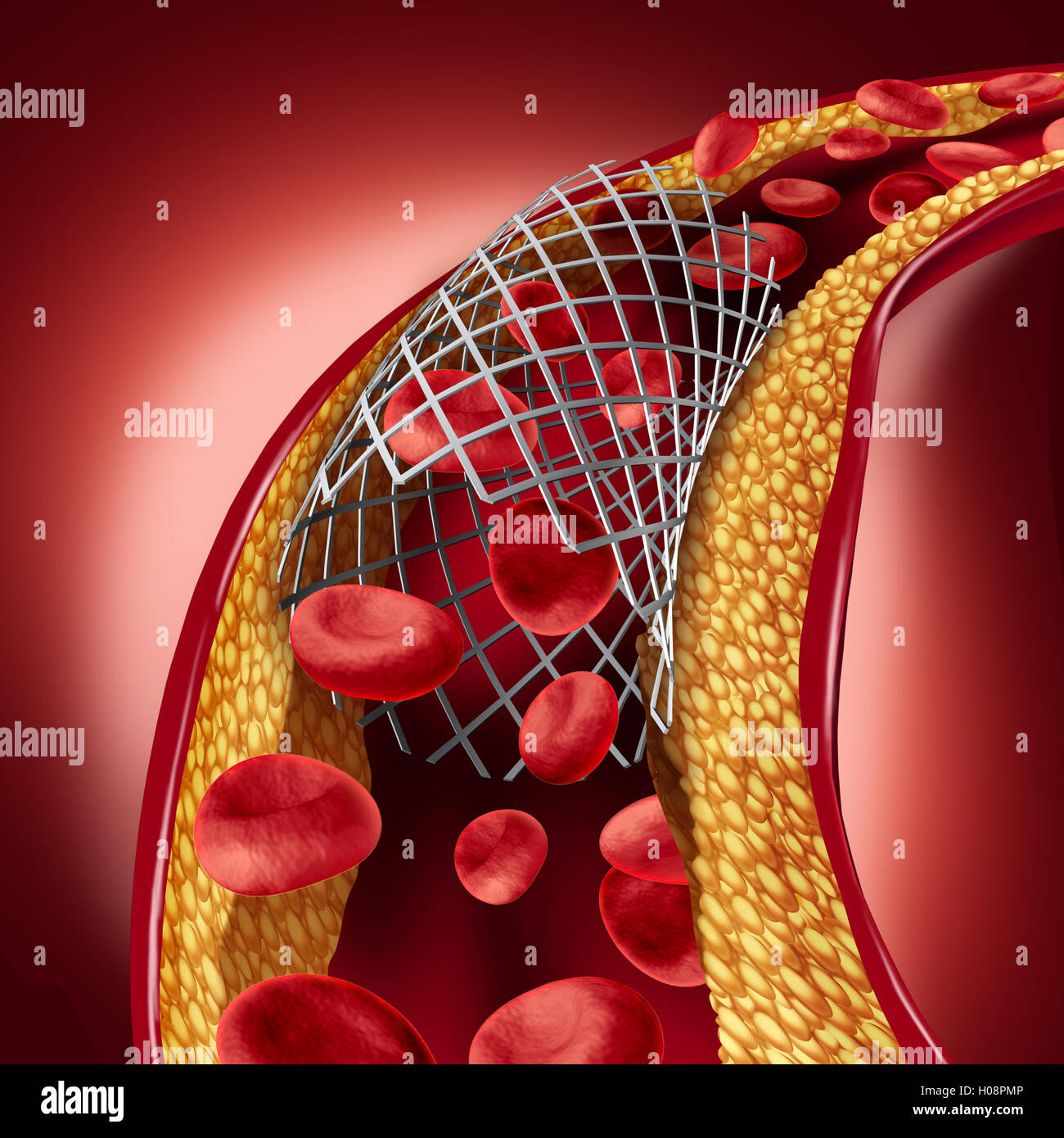 Stent implant concept as a heart disease treatment symbol with an angioplasty procedure in an artery that has cholesterol plaque blockage being opened for increased blood flow as a 3D illustration. Stock Photo