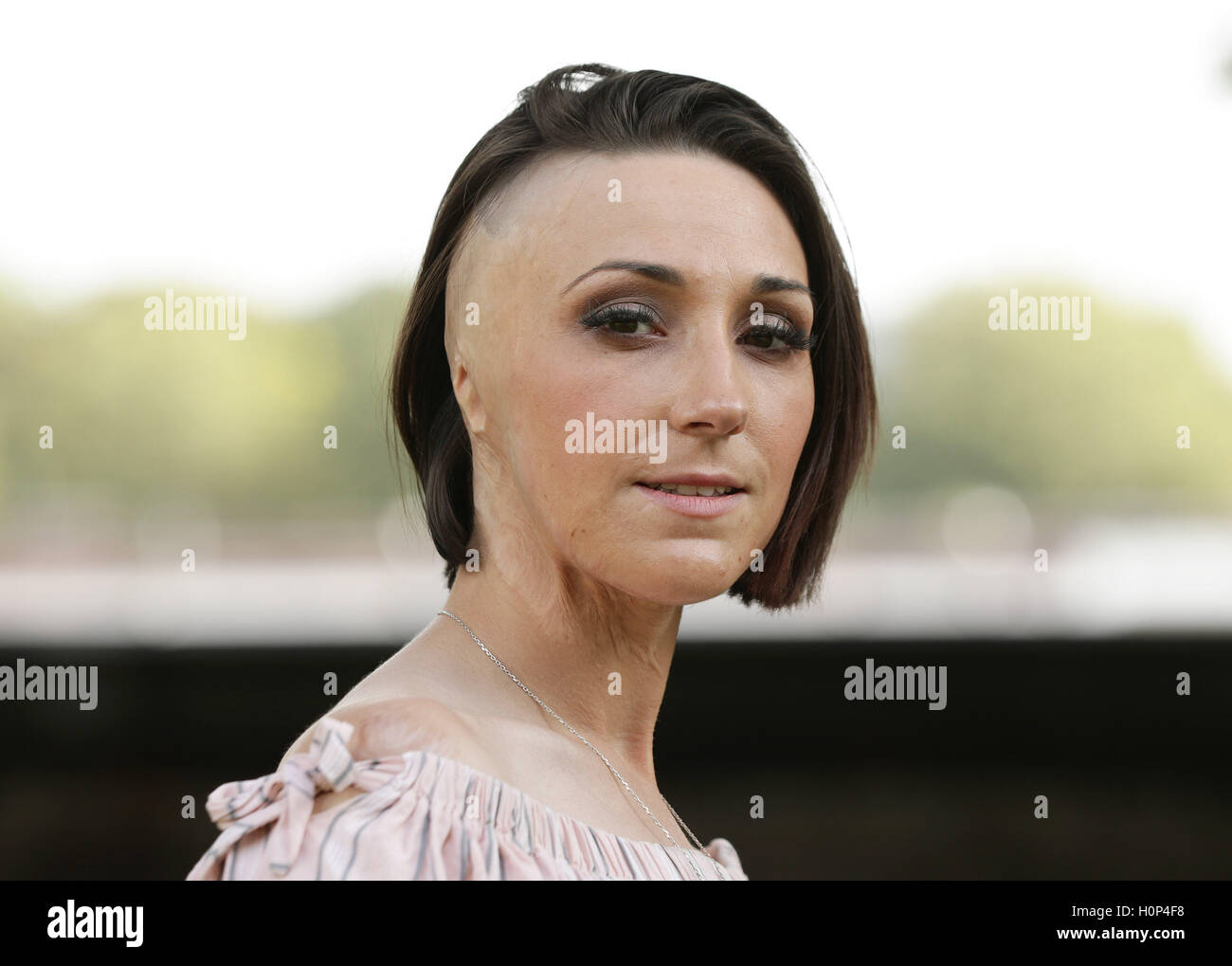 Adele Bellis, 24, who was scarred for life in an acid attack orchestrated by her controlling boyfriend, in Victoria Tower Gardens, London. Stock Photo