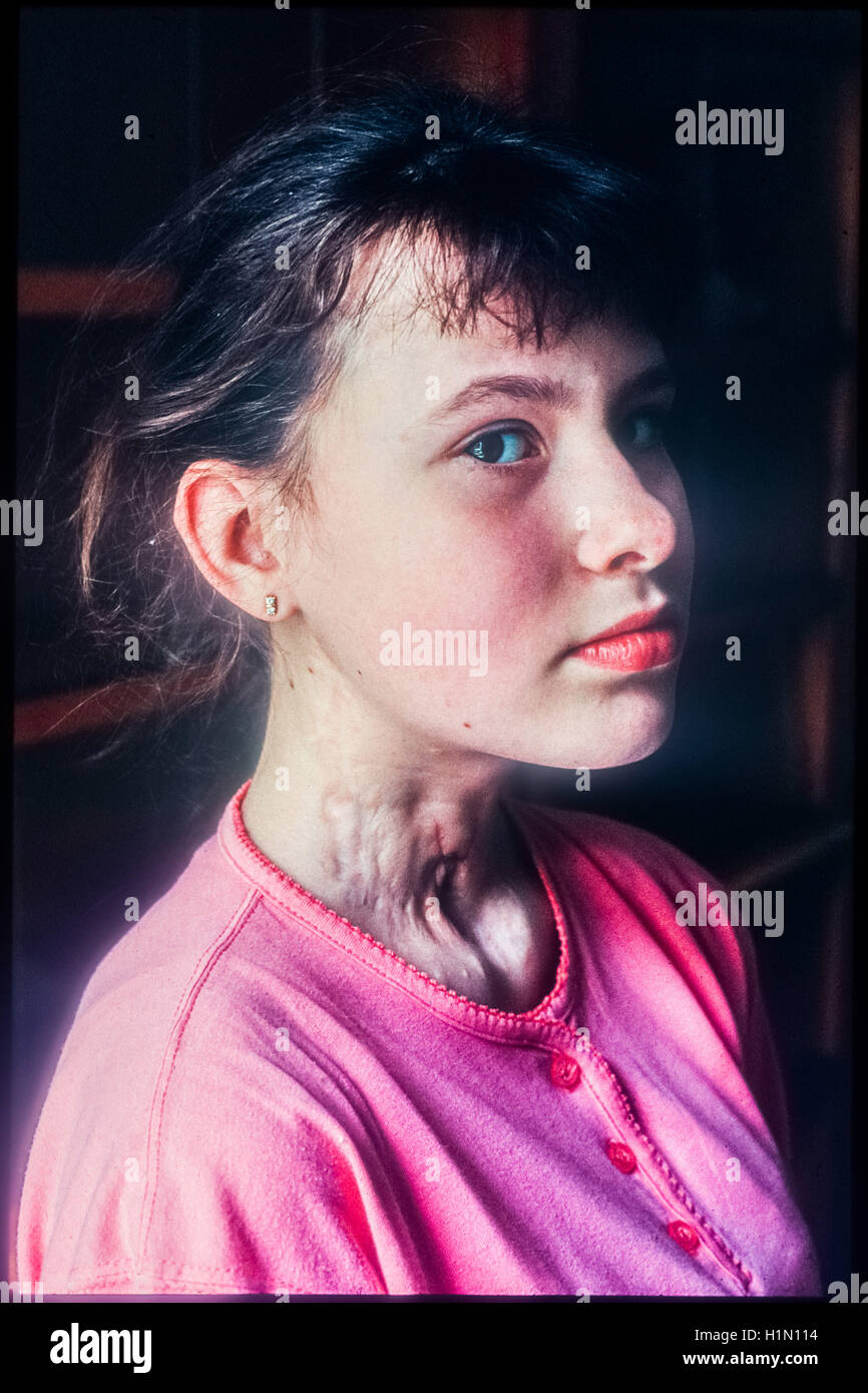 Medical center of Kiev child with thyroid cancer after the Chernobyl ...