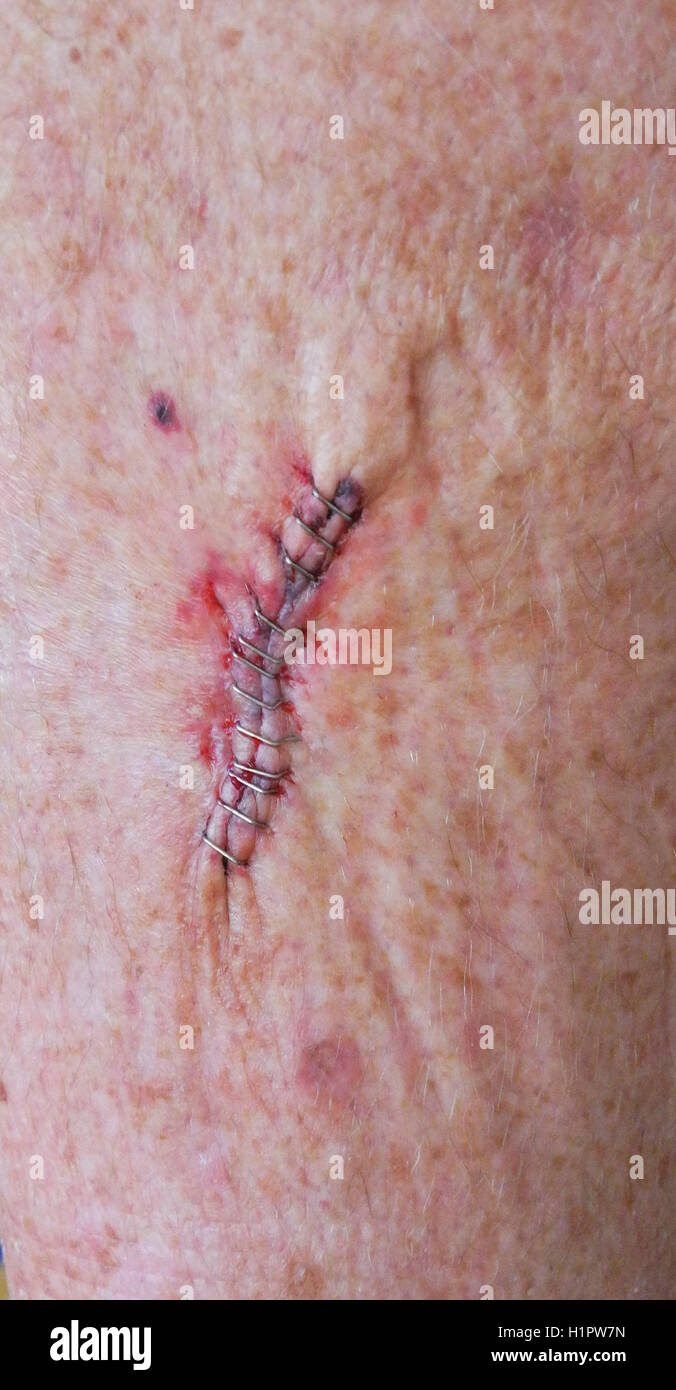 A dozen stainless steel medical staples were used in skin cancer surgery to close the wound after removing a squamous cell carcinoma on the leg of an elderly Caucasian man. Chronic sun exposure is the leading cause of this type of skin cancer, especially in people with fair skin, light hair and blue, green or gray eyes. Using surgical staples to close a wound is faster than suturing it by hand with needle and thread. Stock Photo
