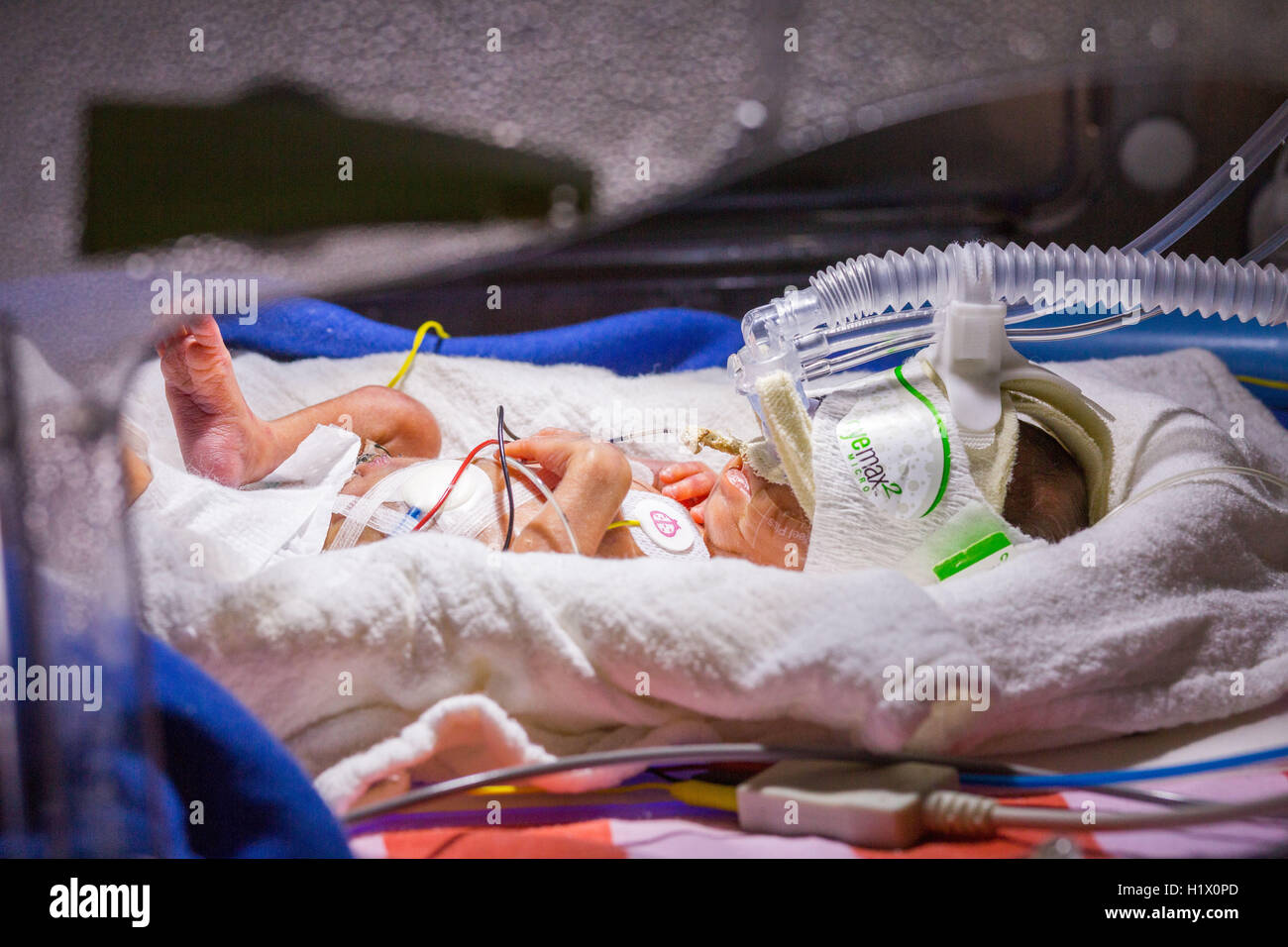 Premature newborn baby undergoing ultraviolet light treatment for jaundice. Stock Photo