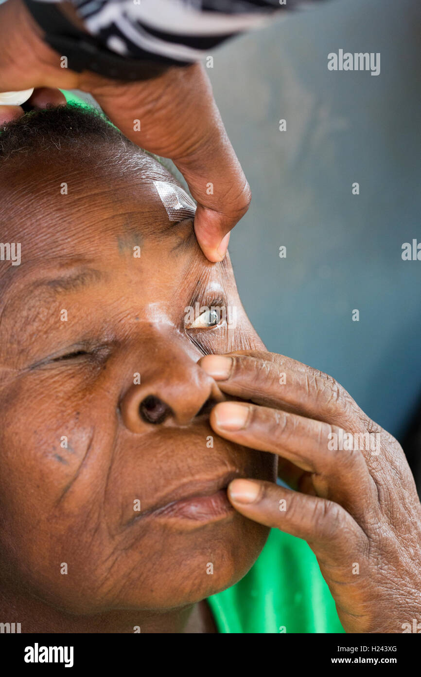 Ribaue Hospital, Ribaue,  Nampula Province, Mozambique, August 2015. A cataract is clearly visible on this patient after being given drops to dialate the pupil and soon to have her operation to remove the cataract. Photo by Mike Goldwater Stock Photo