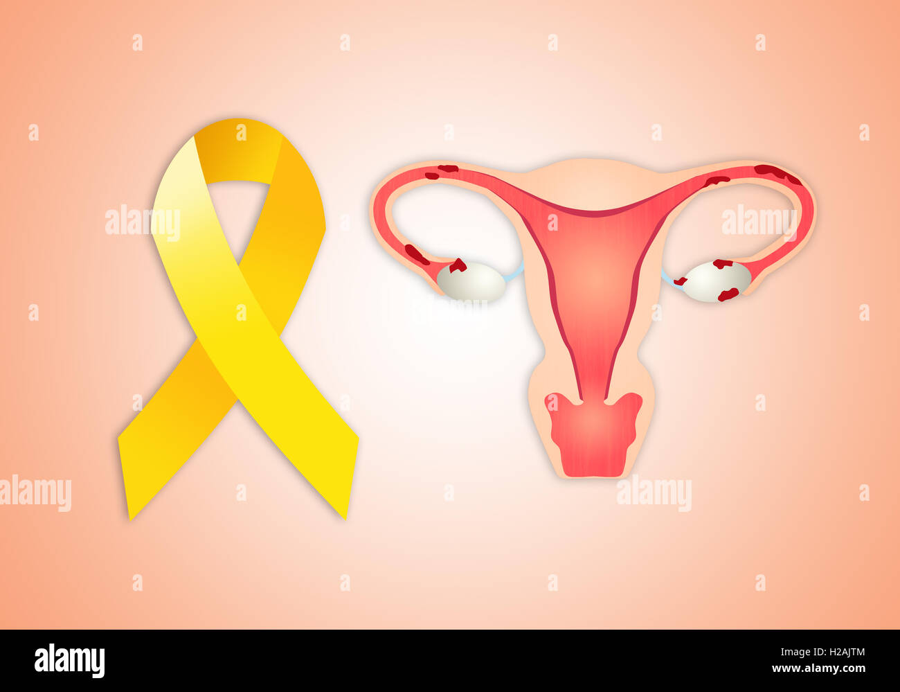 uterus with endometriosis with yellow ribbon Stock Photo Alamy