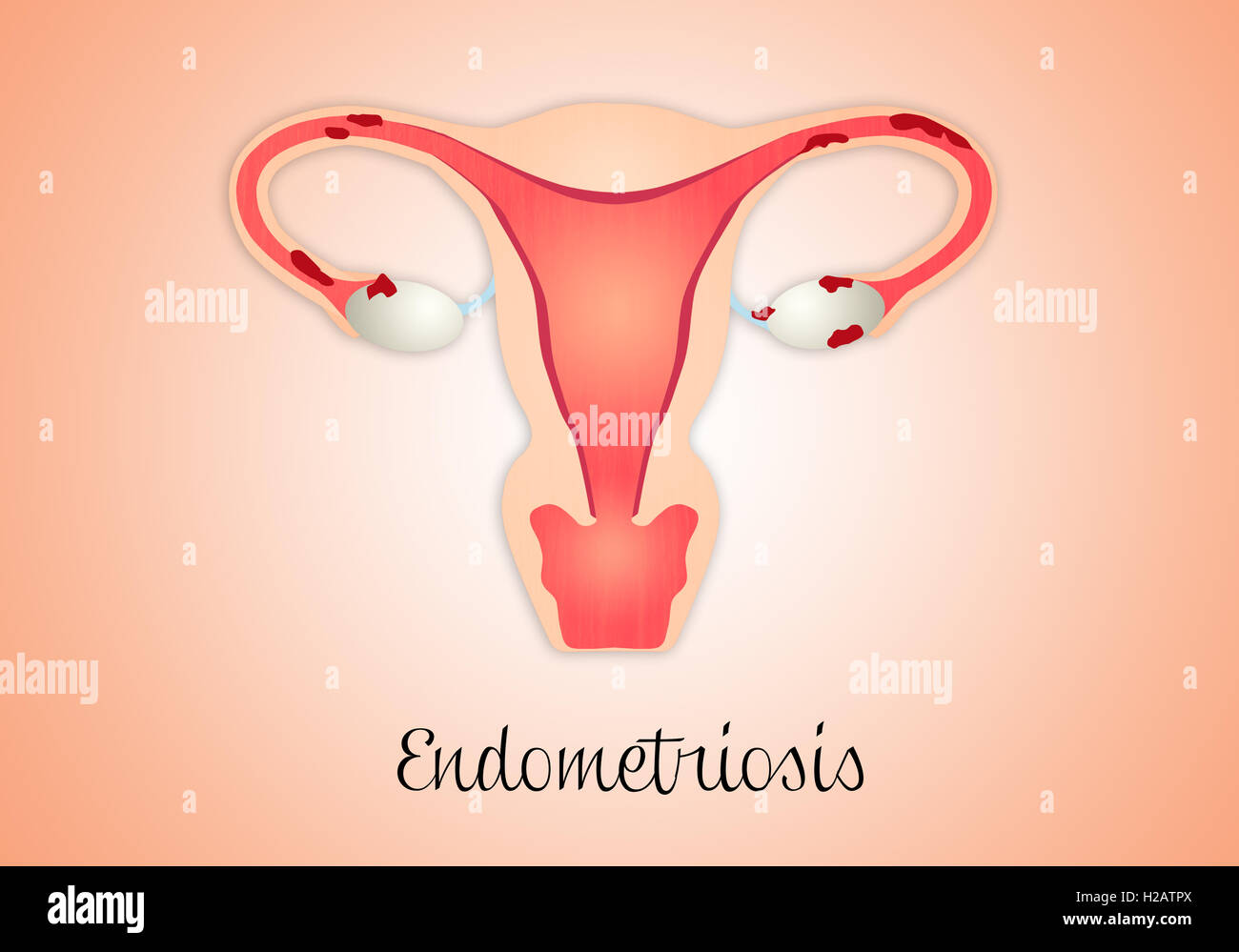 Uterus with endometriosis Stock Photo