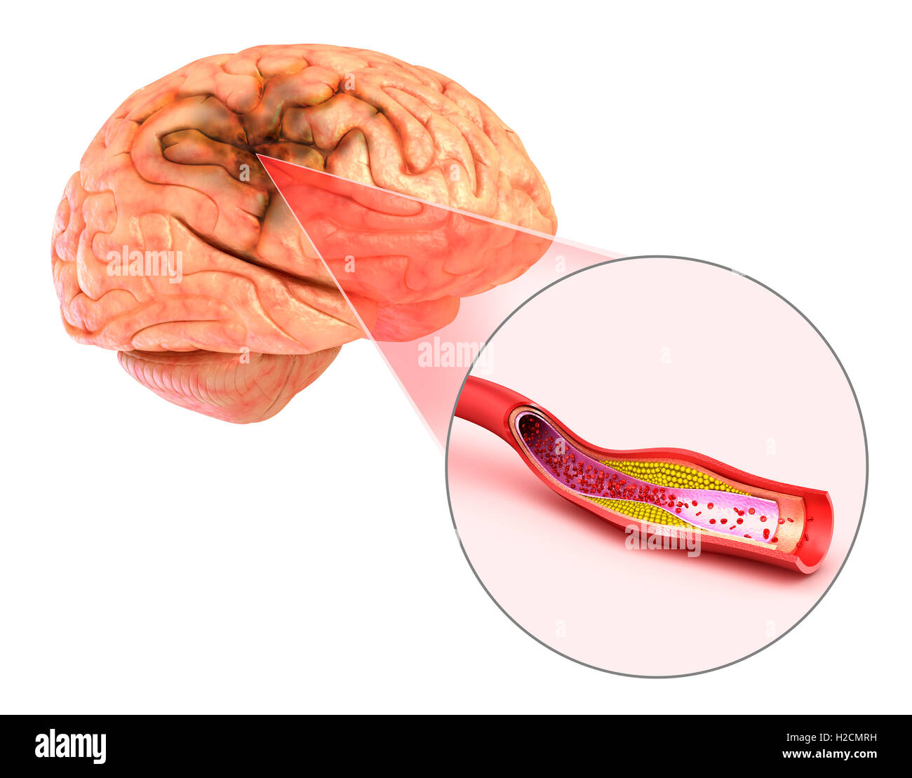 Brain stroke : 3d illustration of the vessels of the brain and causes of stroke Stock Photo