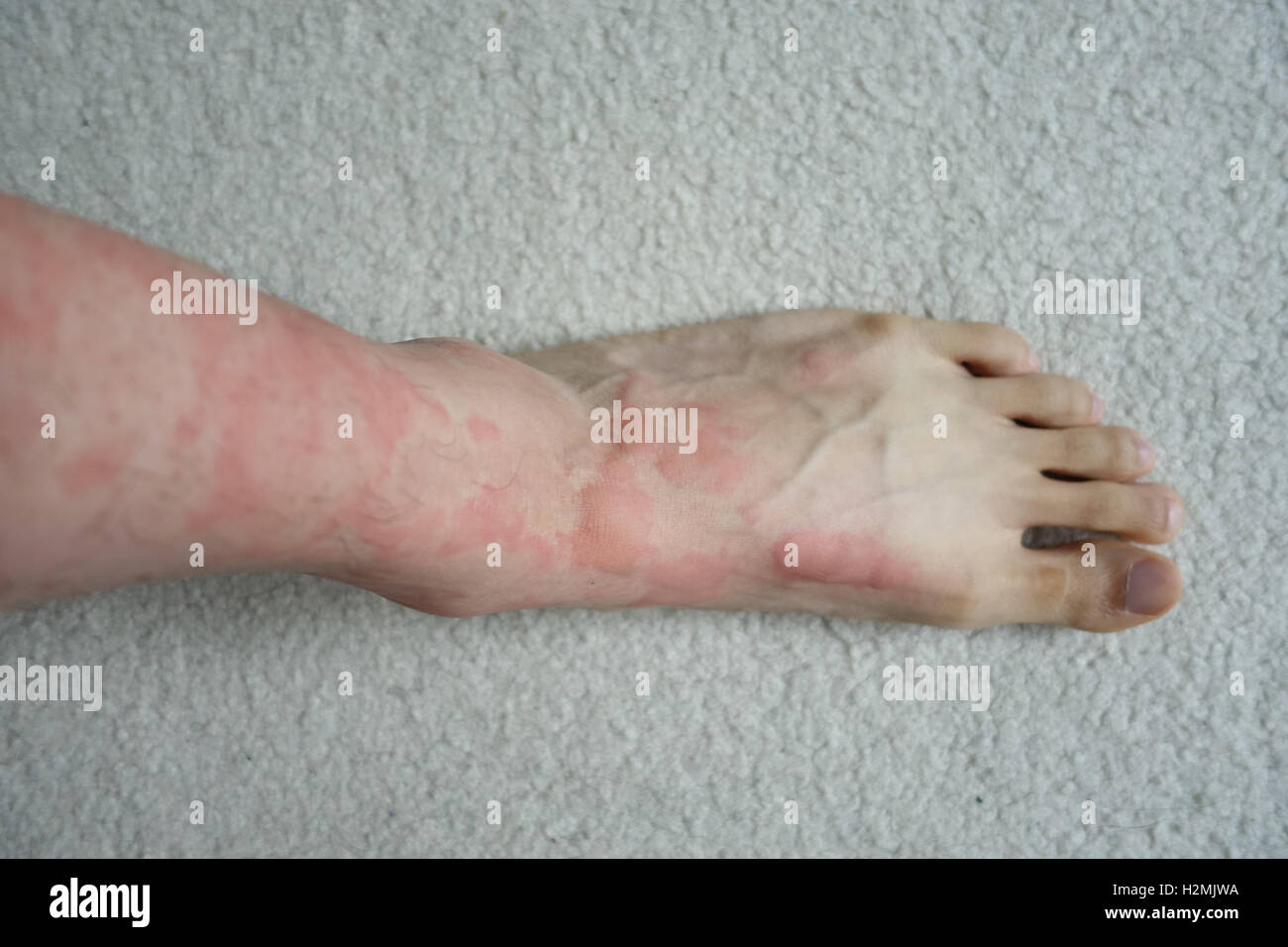 skin allergic reaction hive rash leg foot Stock Photo
