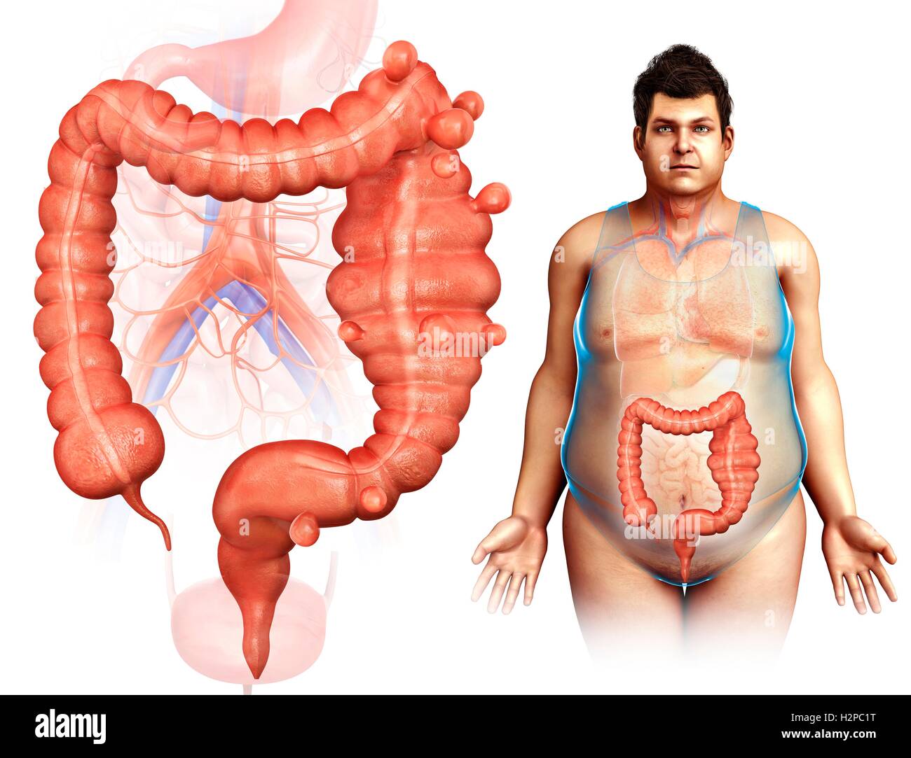 Illustration of a man with diverticulosis and mega colon. Stock Photo