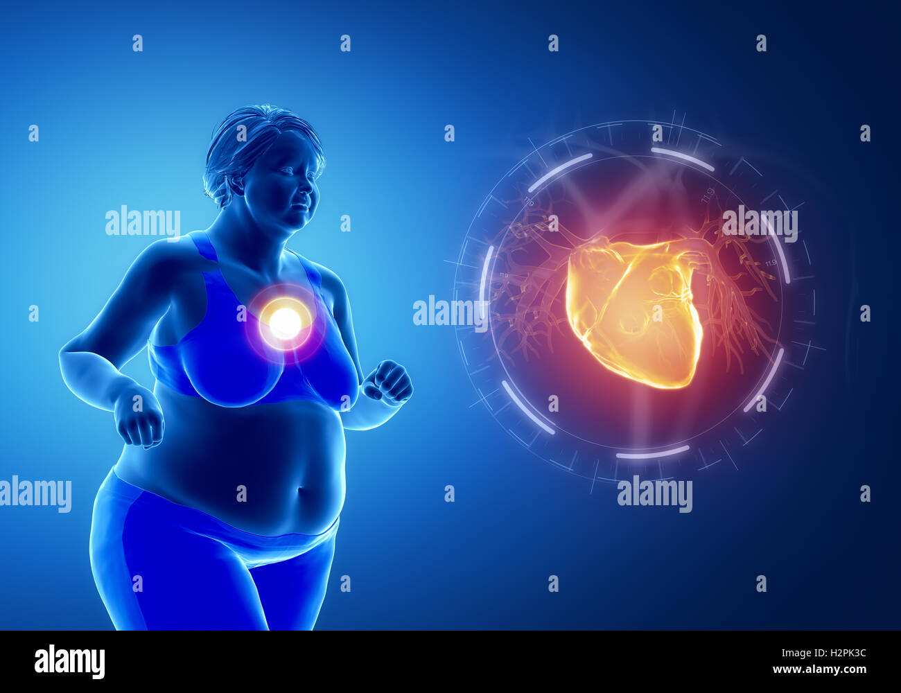 Ожирение и сердечно сосудистые заболевания. Лишний вес и влияние на сердце. Висцеральное ожирение и сердце.