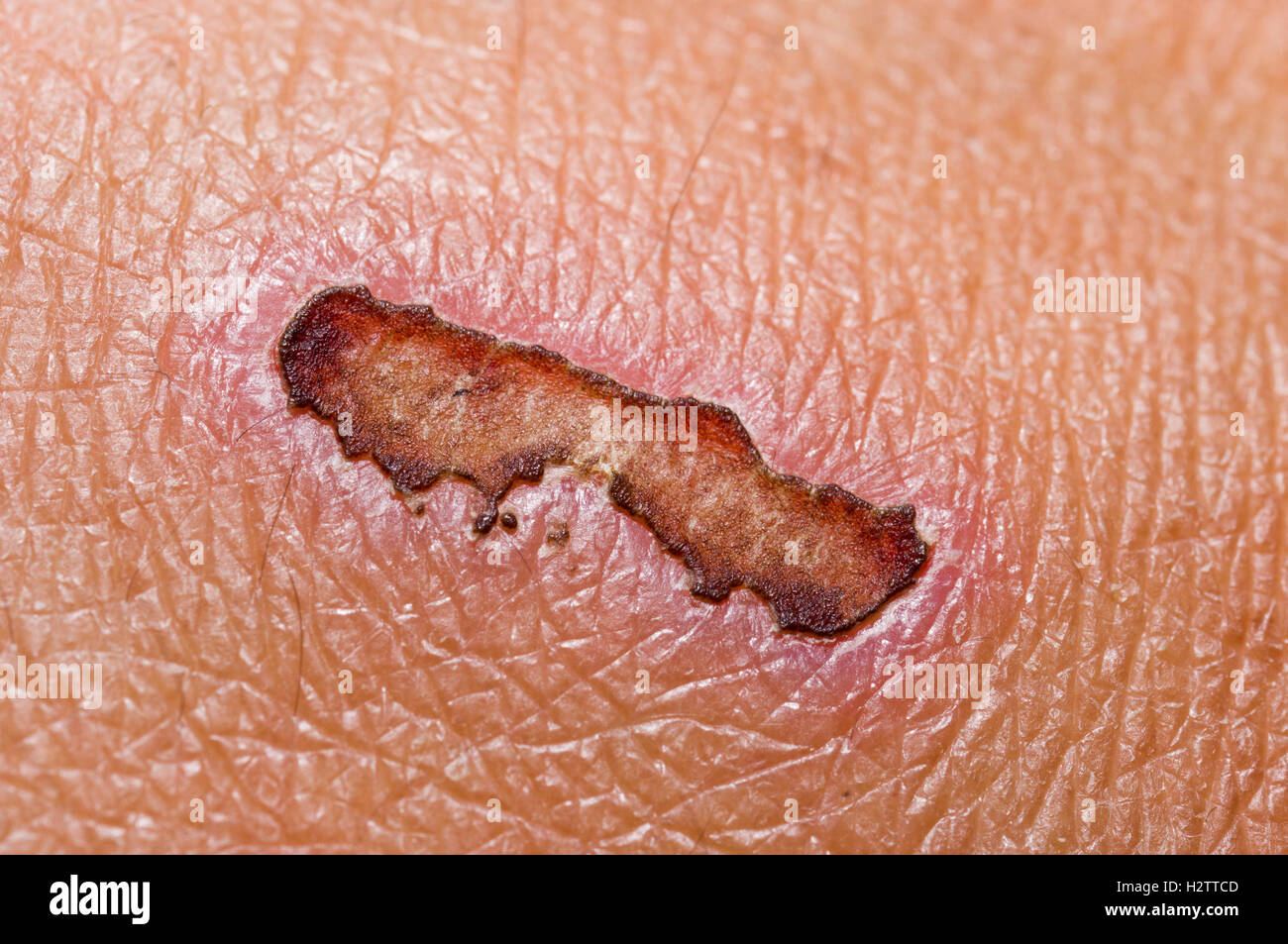 Close up to a scab Stock Photo