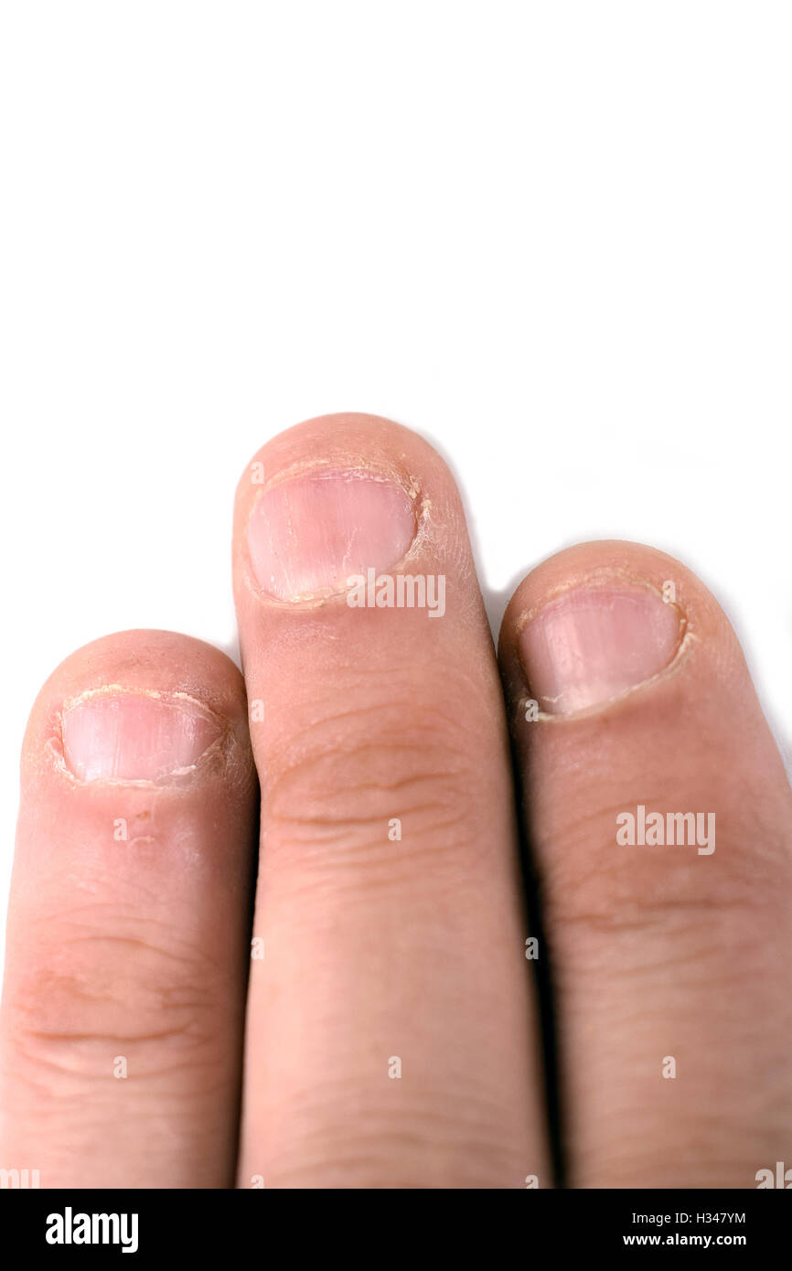 Close up of bitten fingernails isolated on a white background. Stock Photo