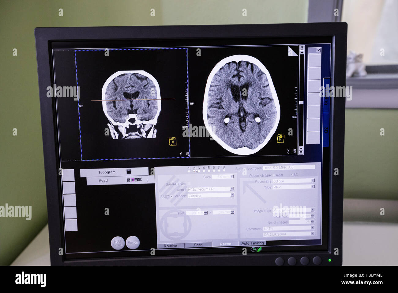 Digital brain scan on computer monitor Stock Photo
