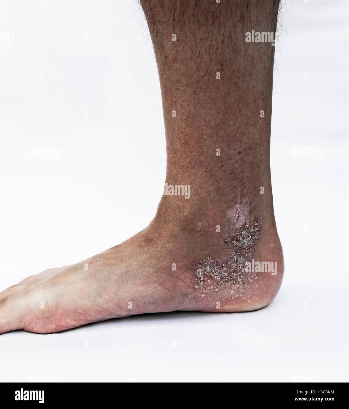 Male ankle and leg with skin condition. Stock Photo