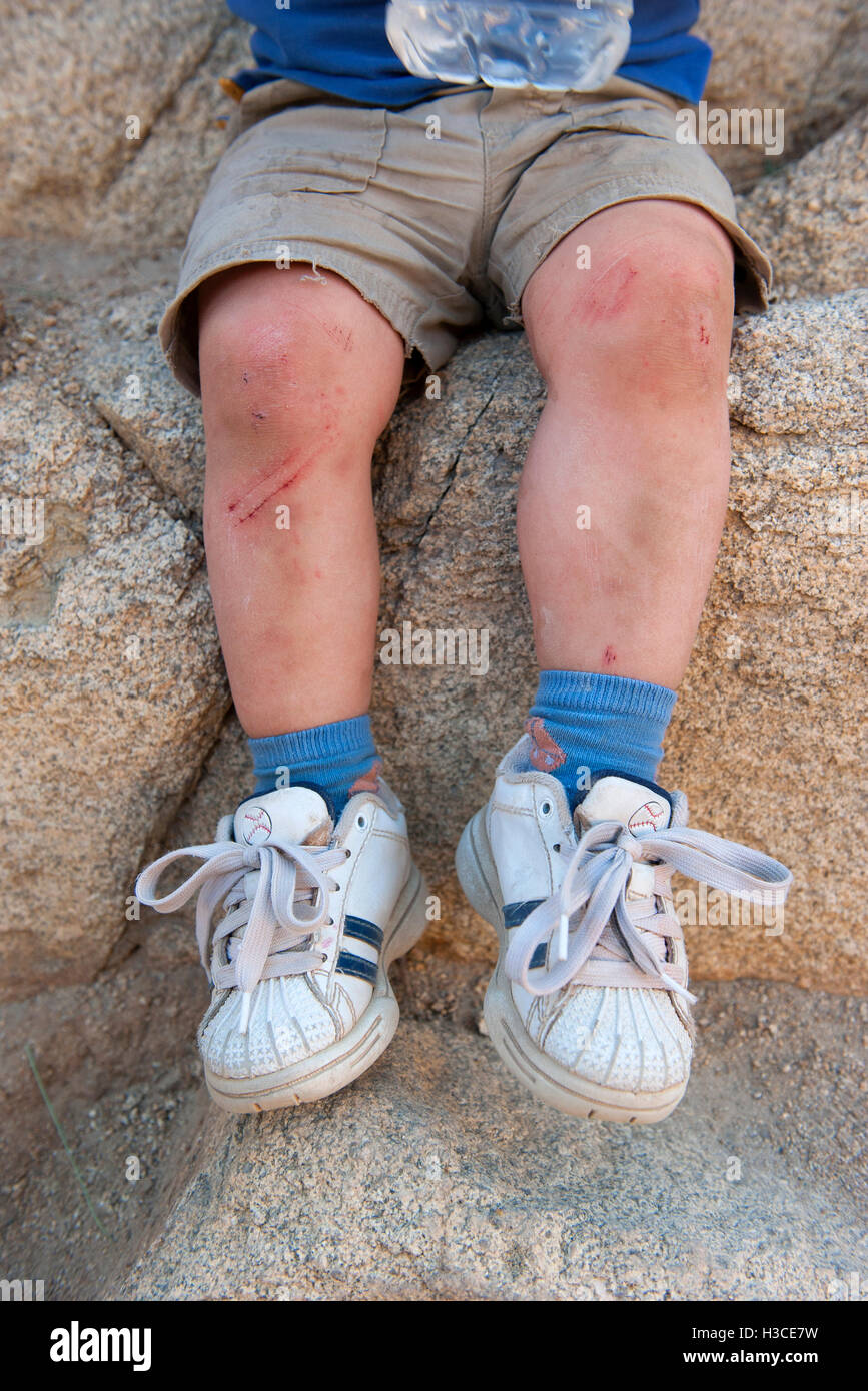 Child's scraped legs Stock Photo
