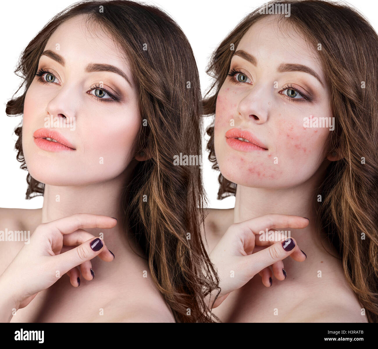 Woman with problem skin on her face Stock Photo