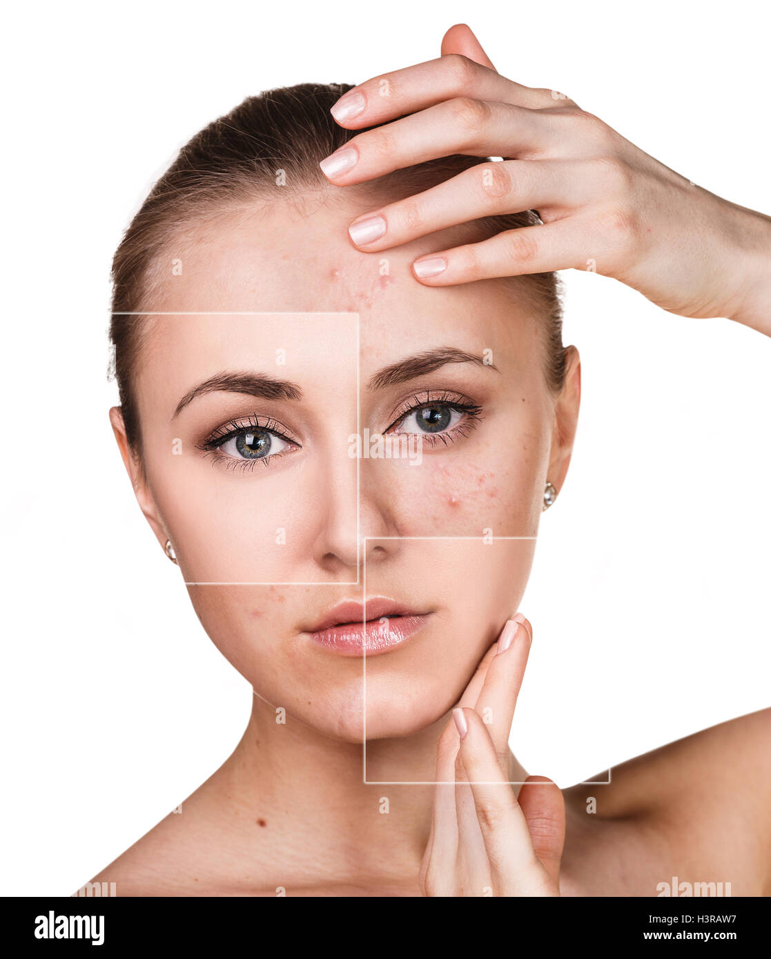 Woman with problem skin on her face Stock Photo Alamy