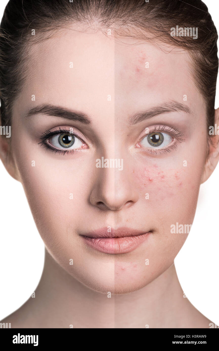 Woman with problem skin on her face Stock Photo Alamy