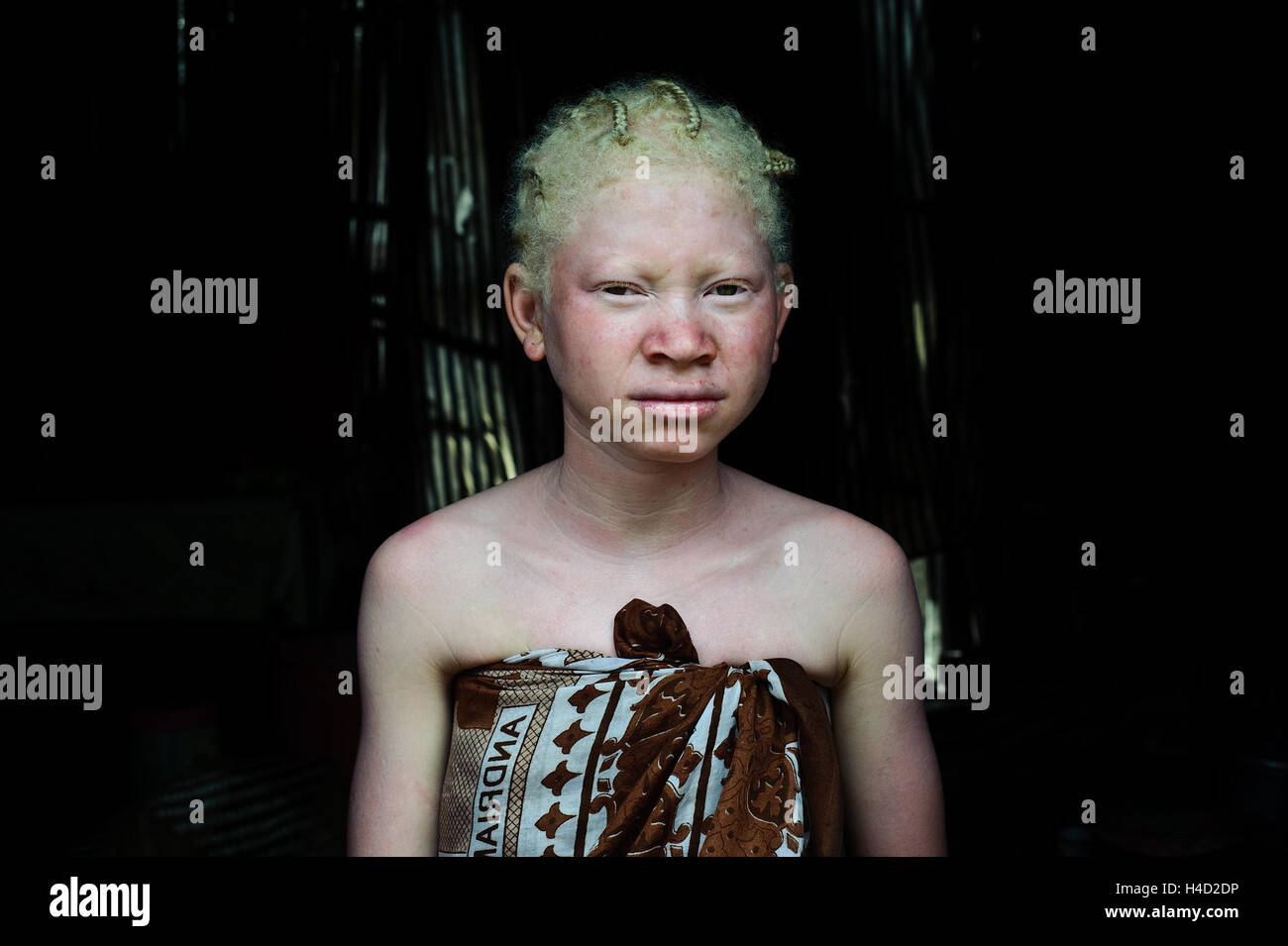 Albino girl ( Madagascar) Stock Photo