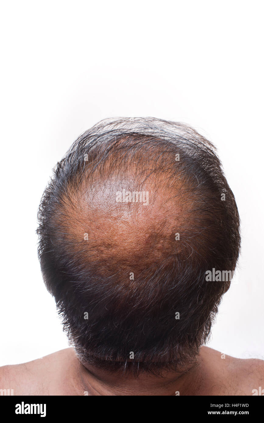 Human alopecia or hair loss, adult man bald head back view Stock Photo