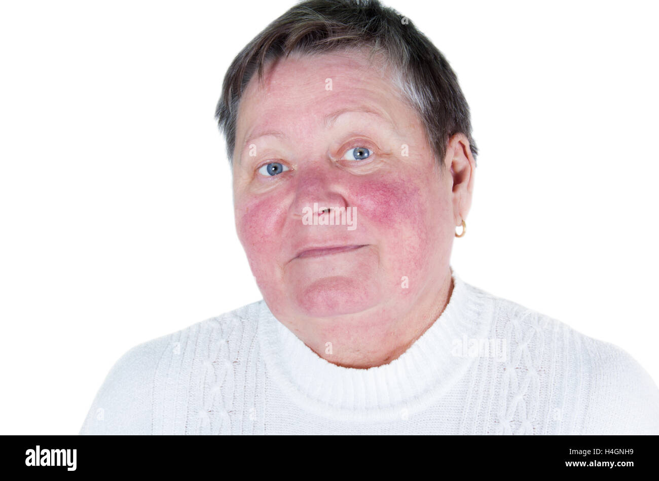 Unhappy elderly woman with skin condition rosacea characterized by facial redness, small and superficial dilated blood vessels, Stock Photo