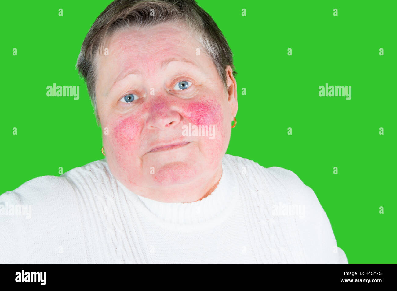 Unhappy elderly woman with skin condition rosacea characterized by facial redness, small and superficial dilated blood vessels, Stock Photo